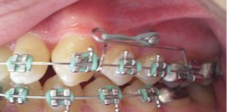 Mini Implante e Ortodontia