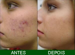 Sinais de acne