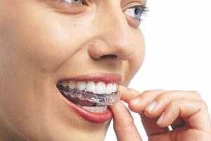 Clareamento Dental Convencional