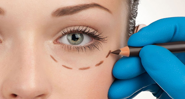 Blaferoplastia
