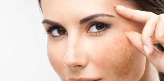 Mulher morena com manchas de melasma no rosto