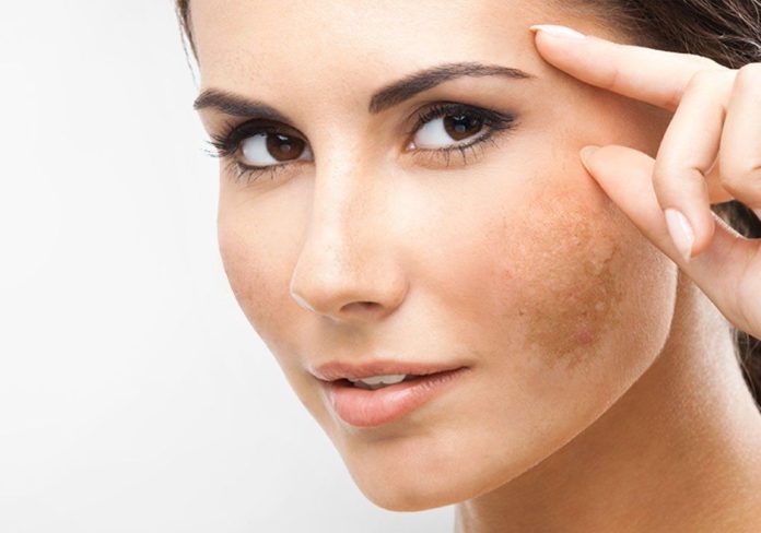 Mulher morena com manchas de melasma no rosto