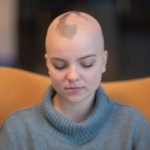 Mulher branca jovem com alopecia