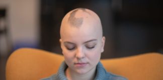 Mulher branca jovem com alopecia