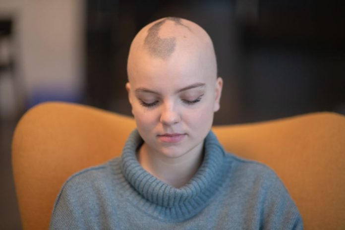 Mulher branca jovem com alopecia
