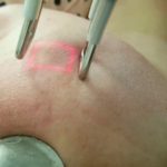 tratamentos a laser na dermatologia
