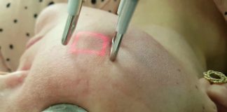 tratamentos a laser na dermatologia